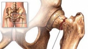 1654837-les-genes-de-l-osteoporose